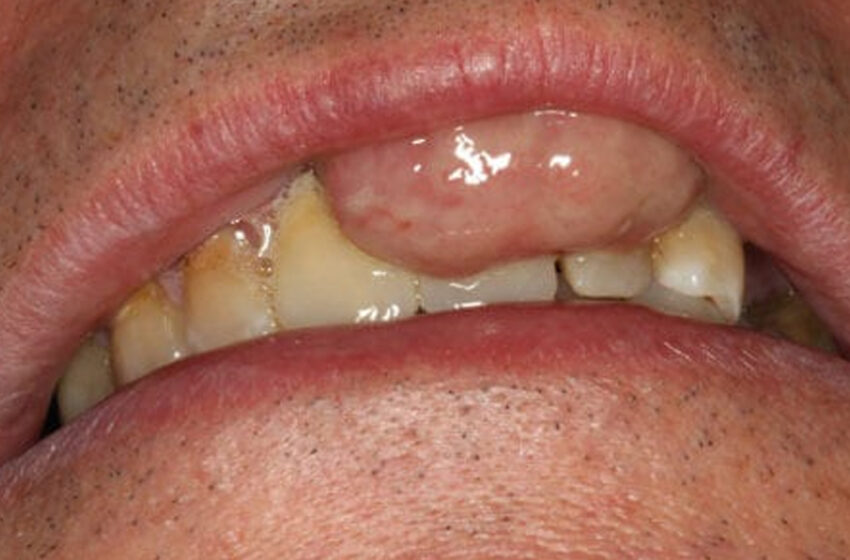  CASO CLÍNICO: GRANULOMA DE CÉLULAS GIGANTES