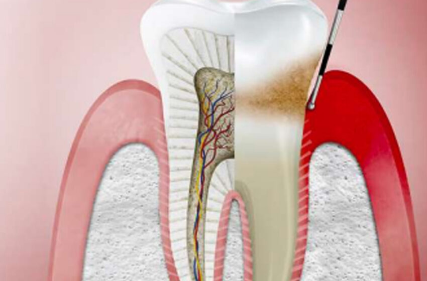  ¿QUÉ ES LA GINGIVITIS? PREVENCIÓN Y TRATAMIENTO