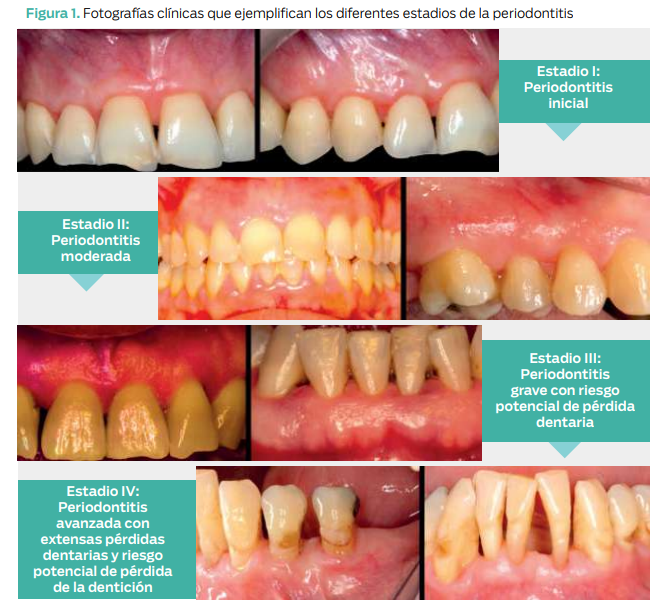 Tipos De Enfermedades Periodontales Gingivitis Y Periodontitis OIDK Tipos De Enfermedades Periodontales Gingivitis Y Periodontitis OIDK