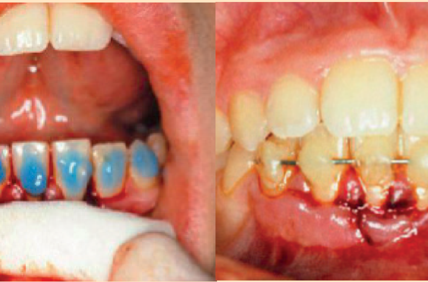  Protocolo de atención del traumatismo dentoalveolar en odontopediatría