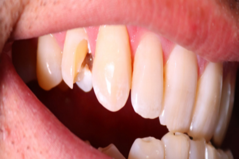  Traumatismos dentoalveolares más frecuentes tras la práctica de deportes de alto impacto