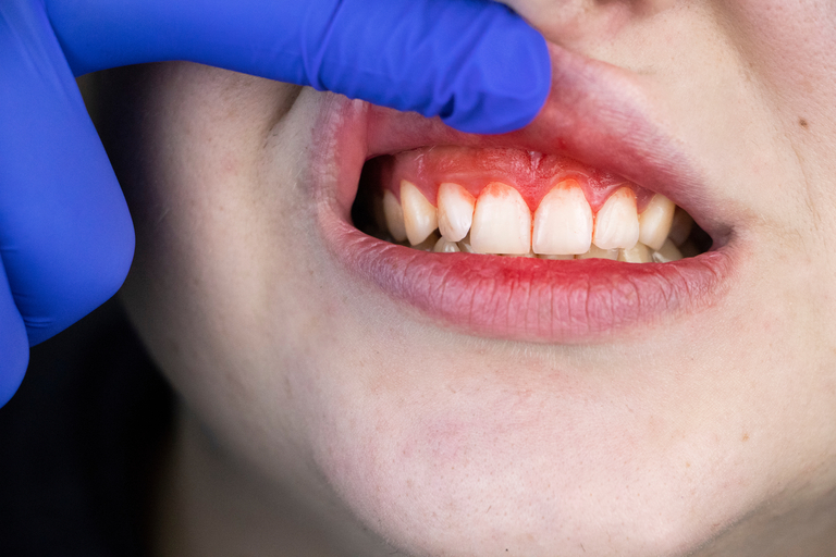  Control de la hemorragia en el consultorio dental