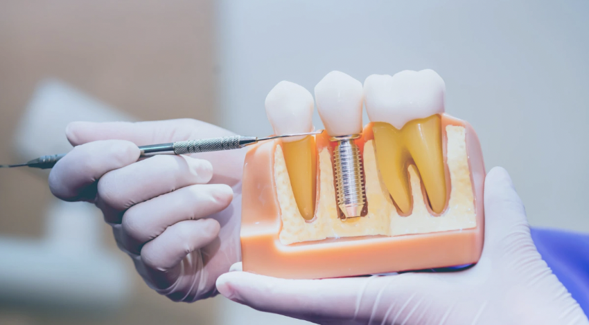  Análisis de implantes inmediatos: ventajas y desventajas